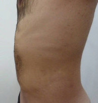 liposuction_after2