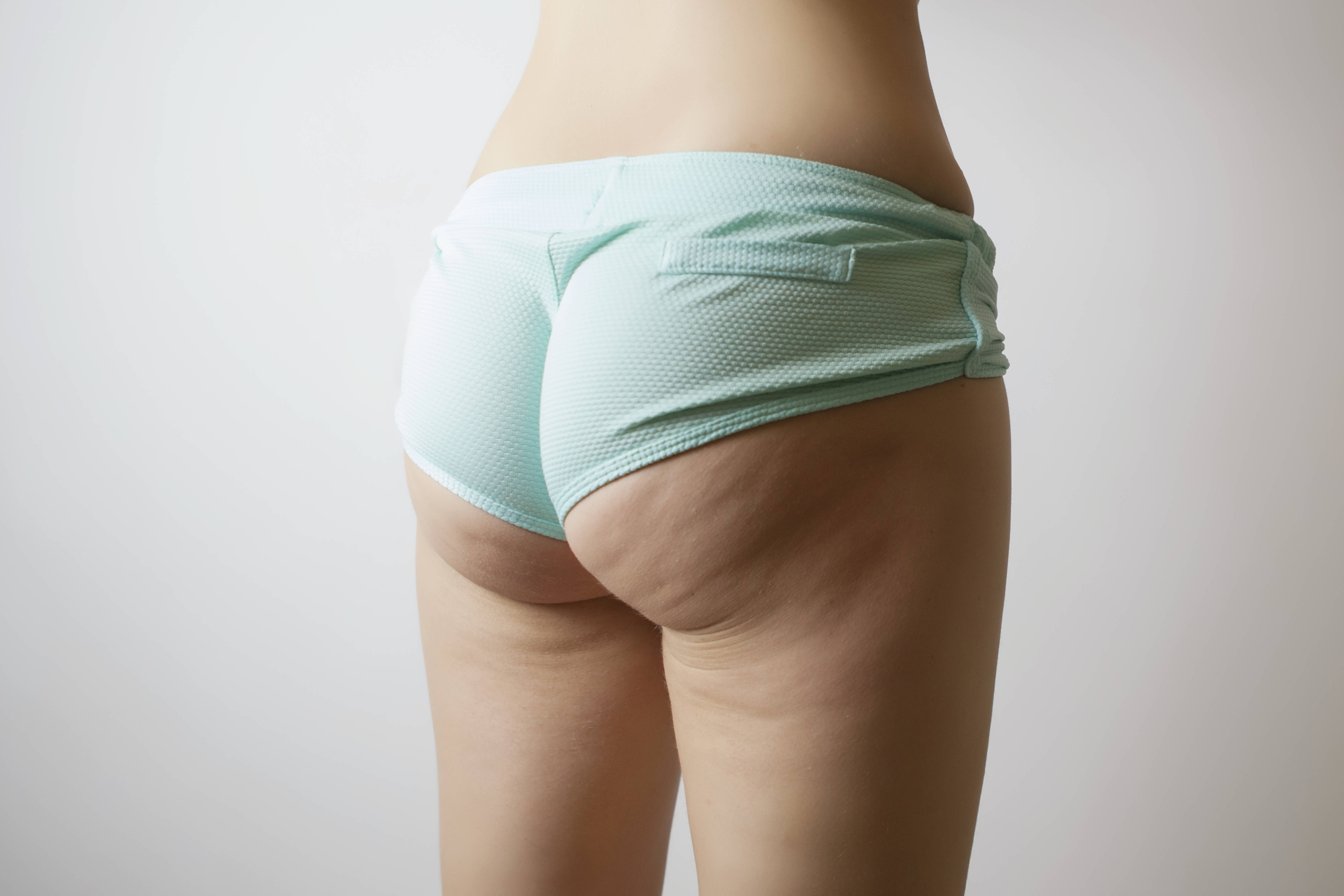 Before-Liposculprture - Brazilian buttock