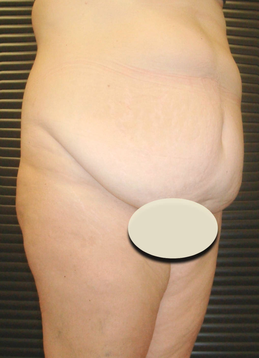 Before-Abdominoplasty