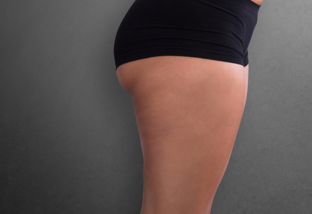 Before-Thigh Lift