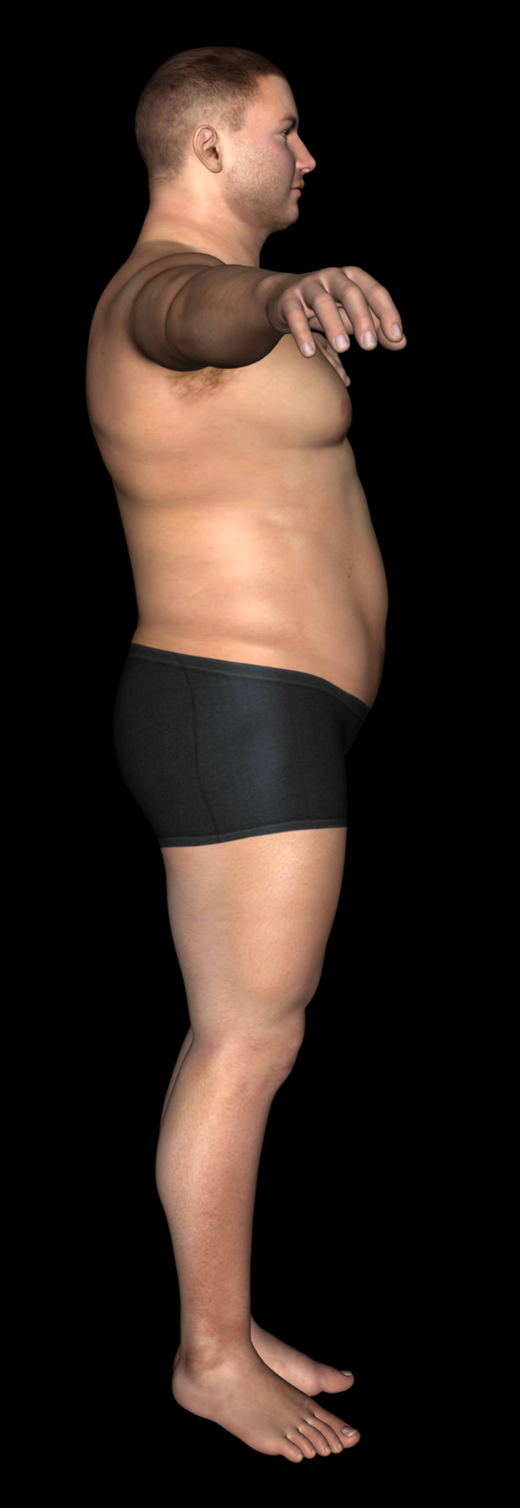 After-Body lift - Post Bariatric Plastic Surgery