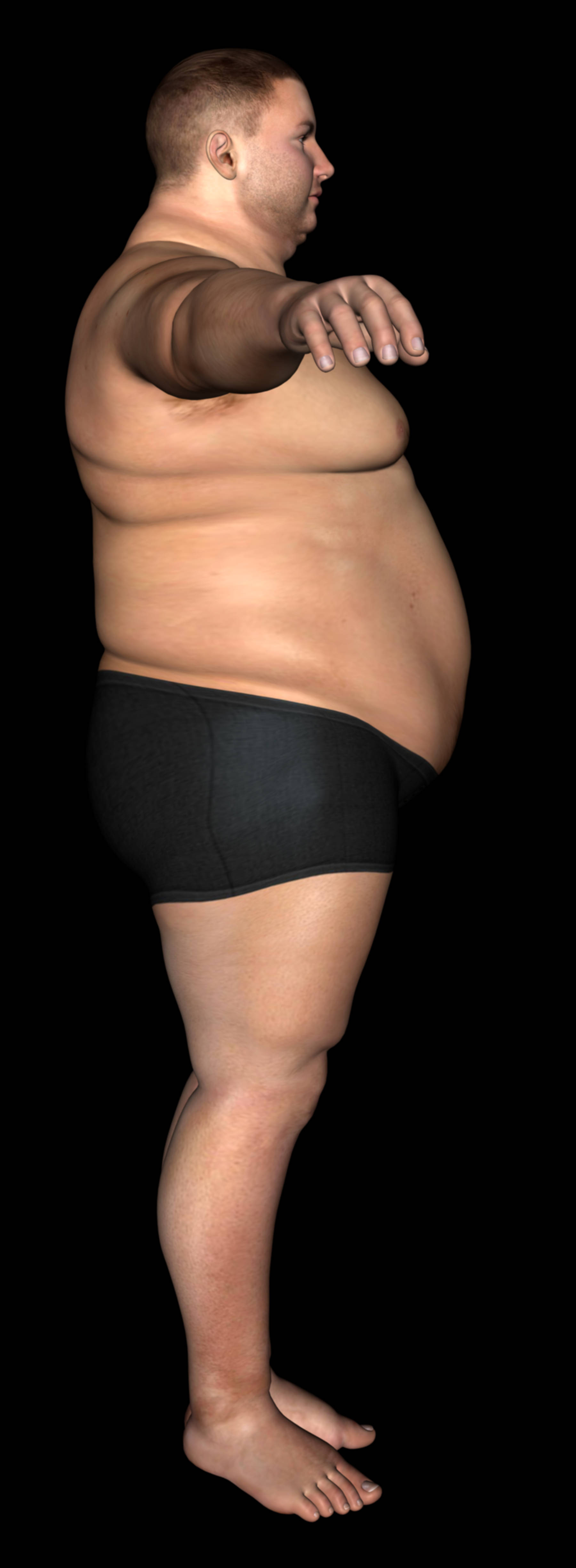 Before-Body lift - Post Bariatric Plastic Surgery