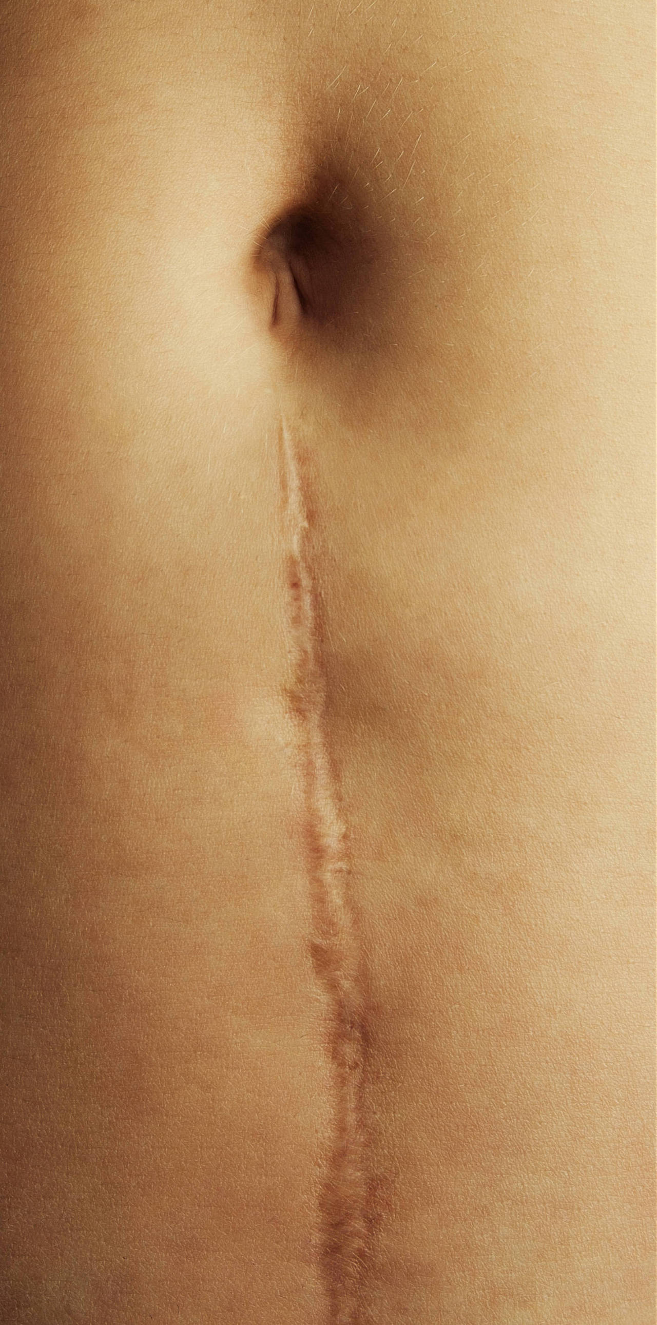 Before-Scar Revision