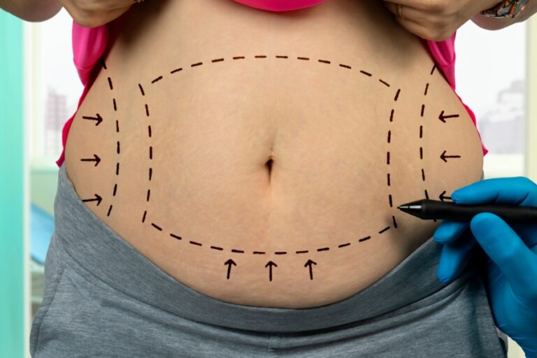 liposuction