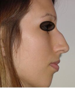 rhinoplasty dubai before and after photos