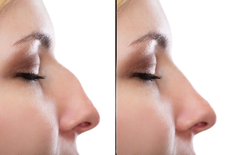 Scarless Rhinoplasty: Reshaping the nose without scars