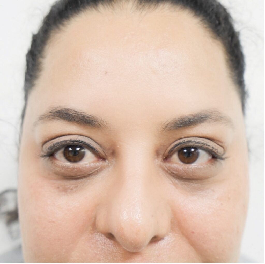 Blepharoplasty (Eyelid surgery)