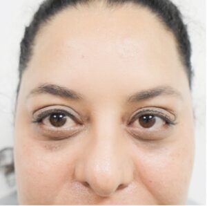 blepharoplasty plastic surgery procedure before and after images 