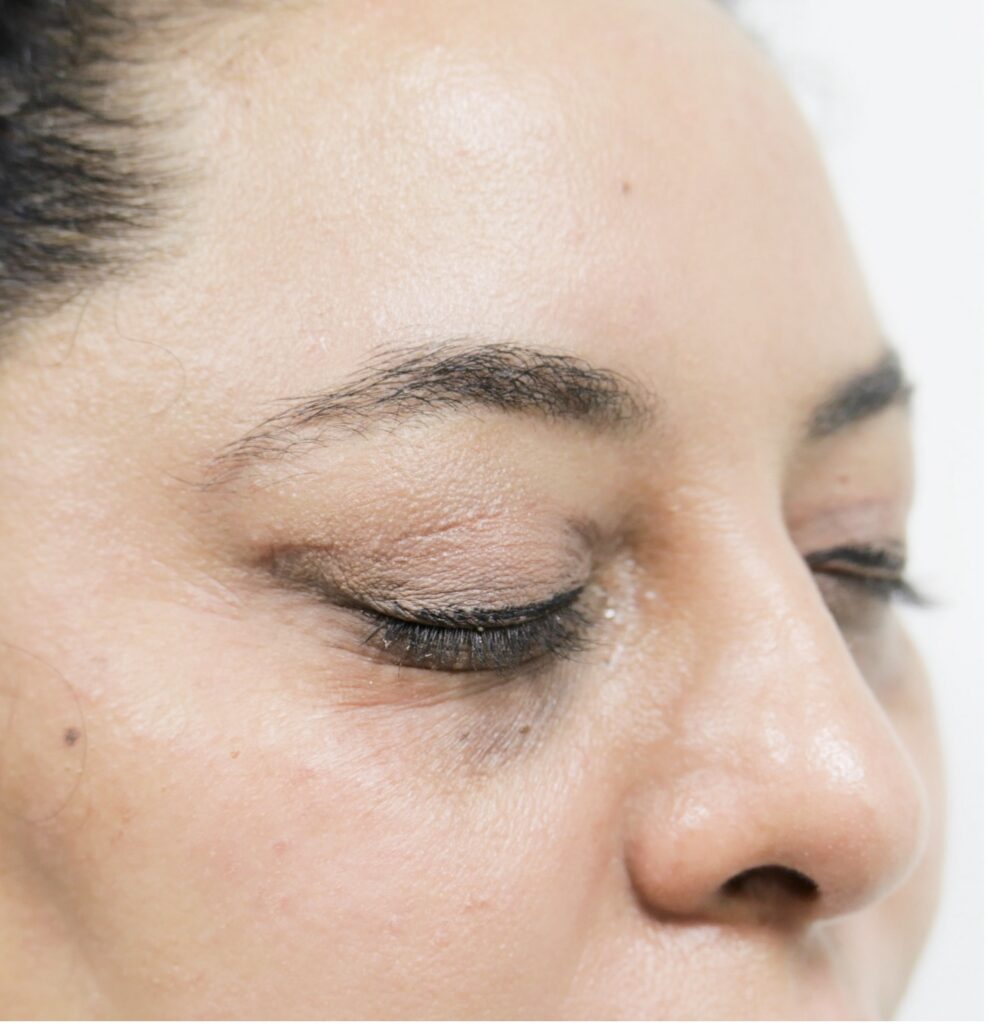 Blepharoplasty (Eyelid surgery)