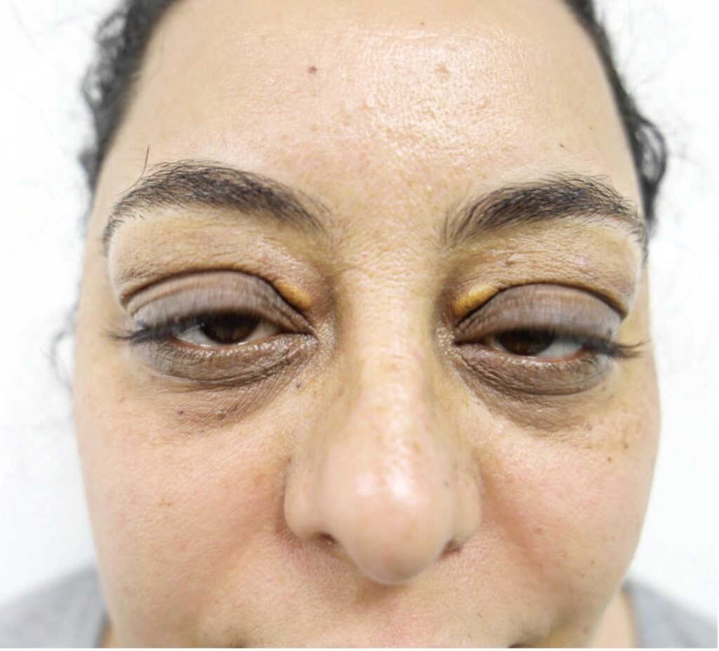 Blepharoplasty (Eyelid surgery)
