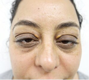 blepharoplasty plastic surgery procedure before and after images 