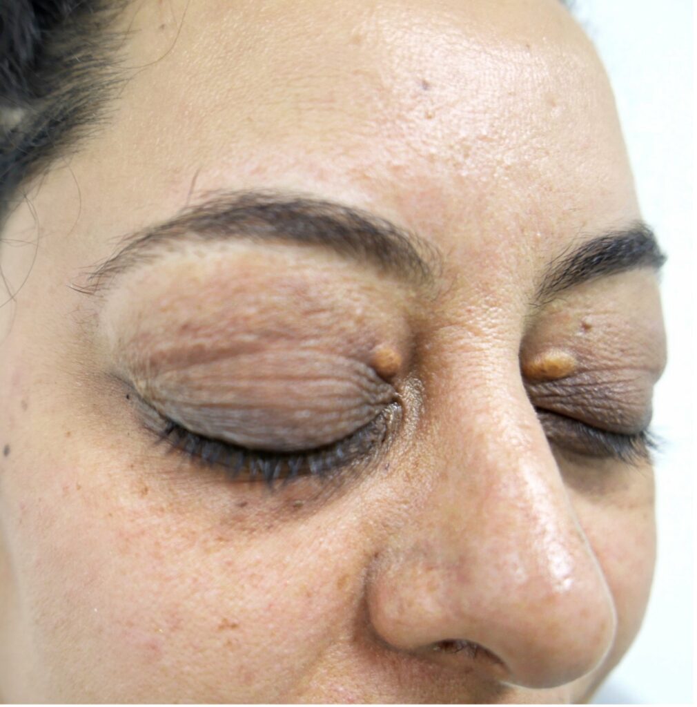 Blepharoplasty (Eyelid surgery)