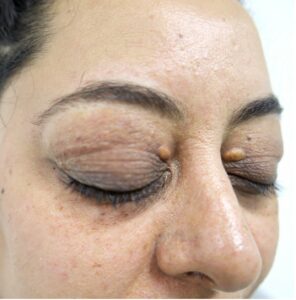 blepharoplasty plastic surgery procedure before and after images 