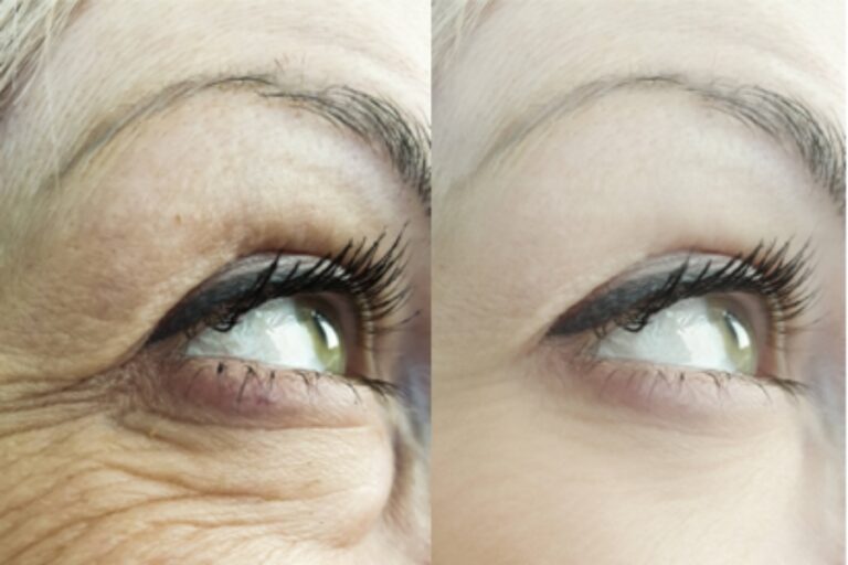 Blepharoplasty (Eyelid surgery)