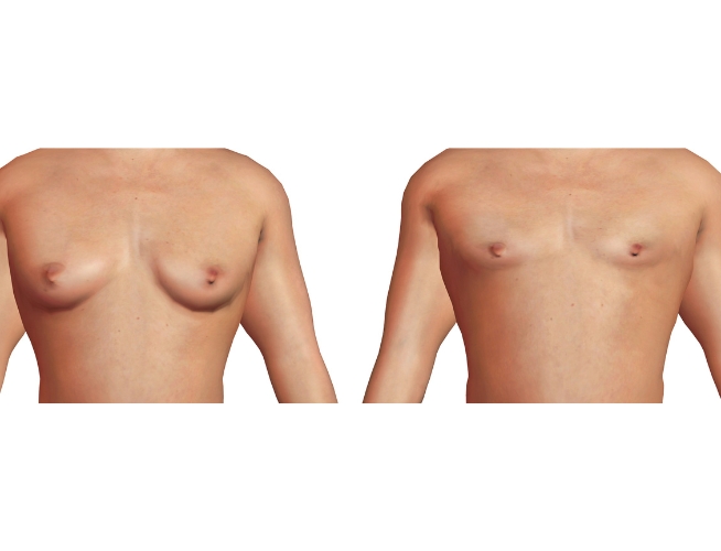 MIGS (Minimally Invasive Gynecomastia Surgery) technique by Dr. Alexandre Dion