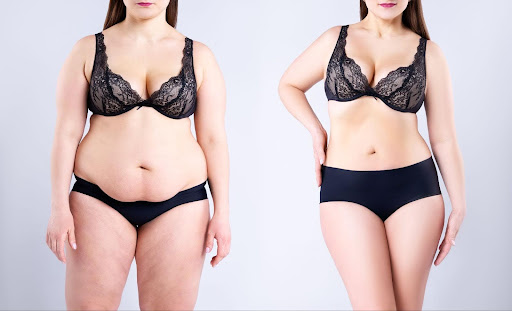 LIPO BEFORE AND AFTER ALL YOU NEED TO KNOW