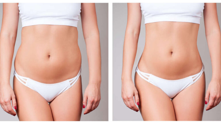 Liposuction vs. Liposculpture: How to Choose the Best for Your Body