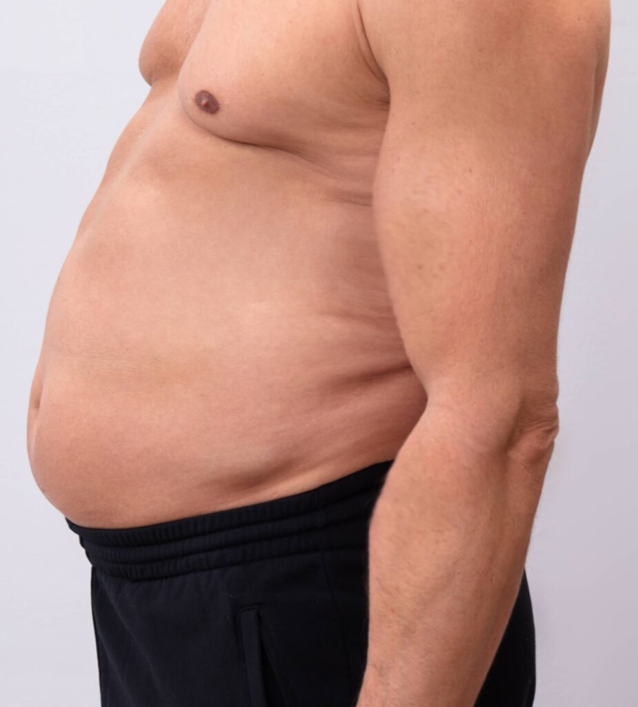 Lipo on Stomach – Sculpting Your Midsection