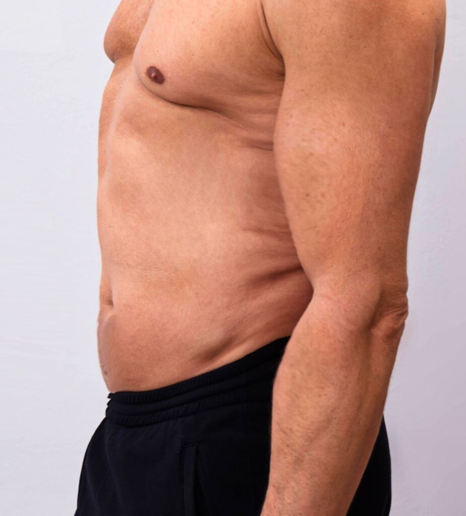 Lipo on Stomach – Sculpting Your Midsection