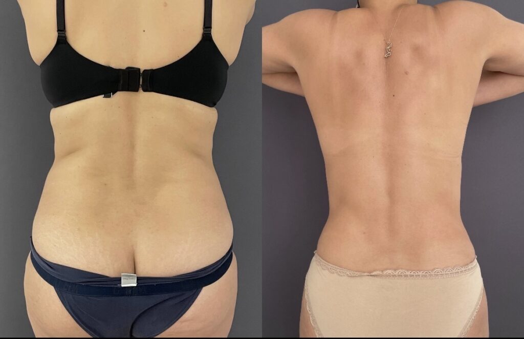 Back-Liposuction-before-and-after