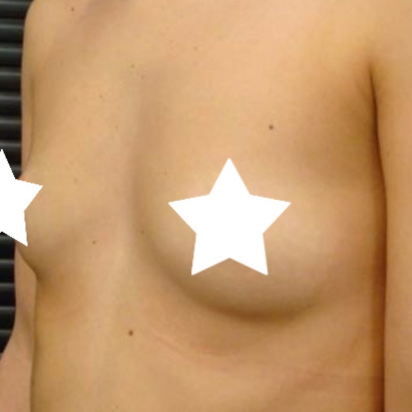 Before-Breast Liposculpture