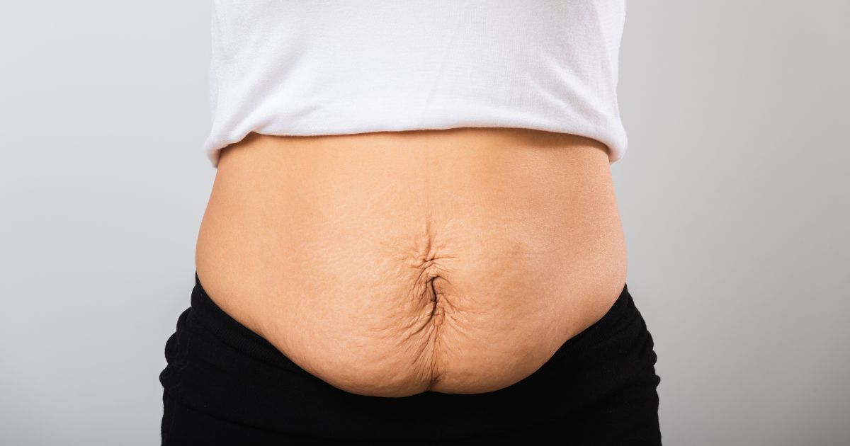 Does Liposuction Cause Loose Skin