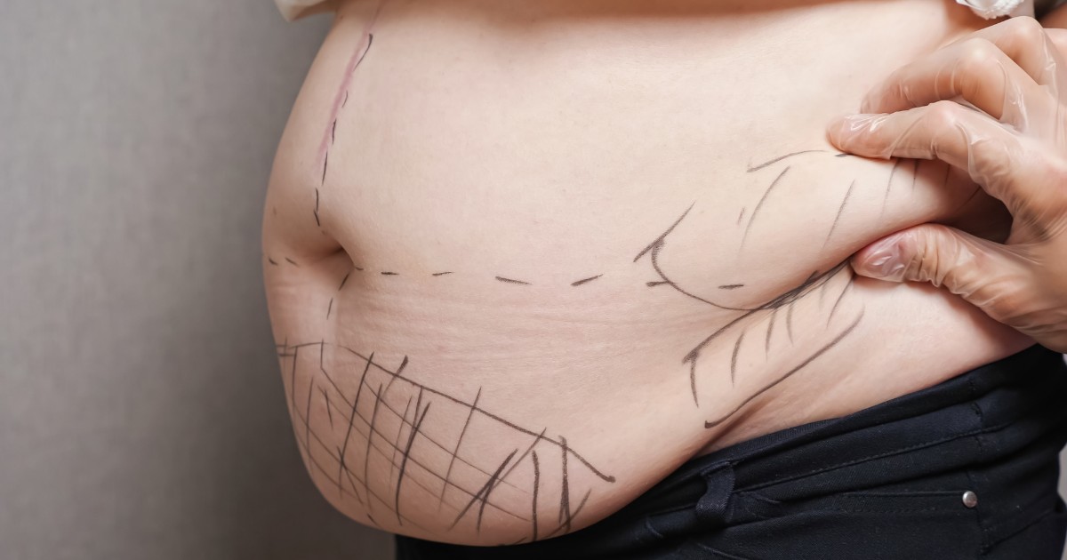 Is Liposuction Safe For Older People