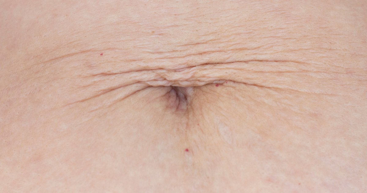 Liposculpture Scars Appearance Treatment and Healing Time