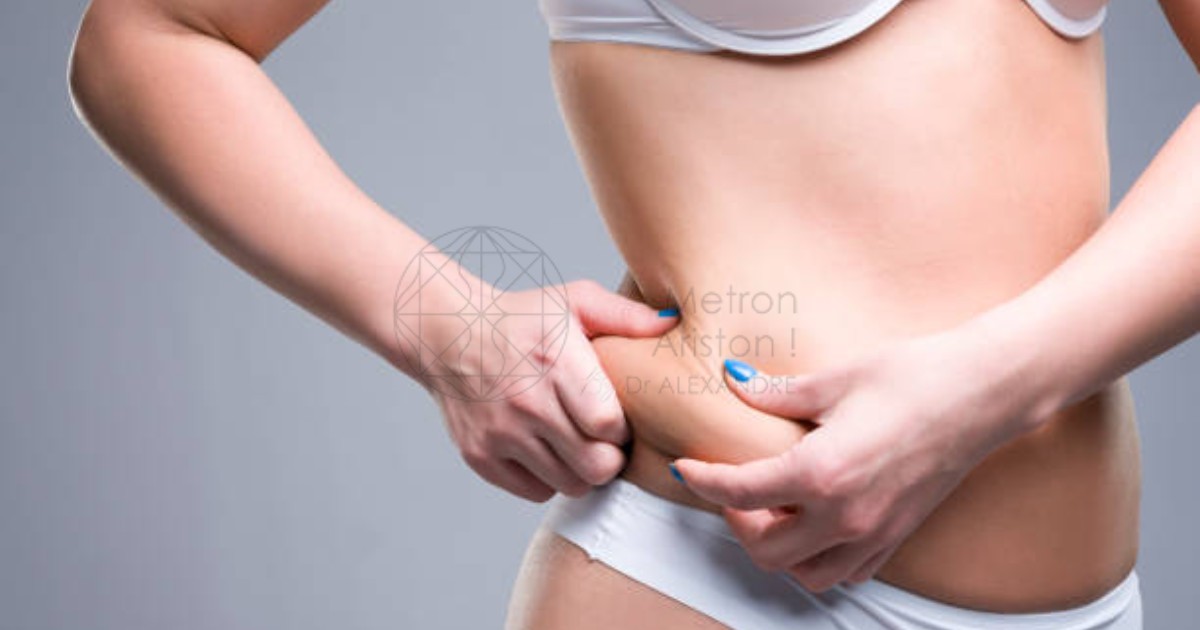 Can Fat From Liposuction Return