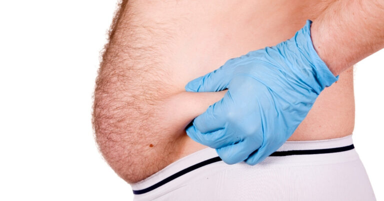 How Much Of A Tummy Tuck Can Be Done With Liposuction