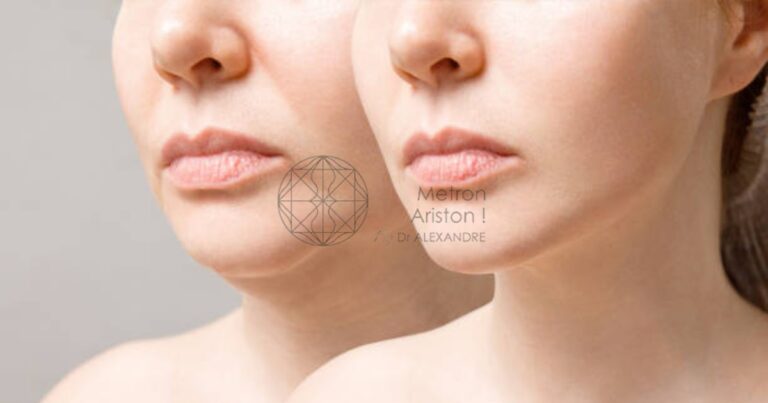 Liposuction Chin Before And After