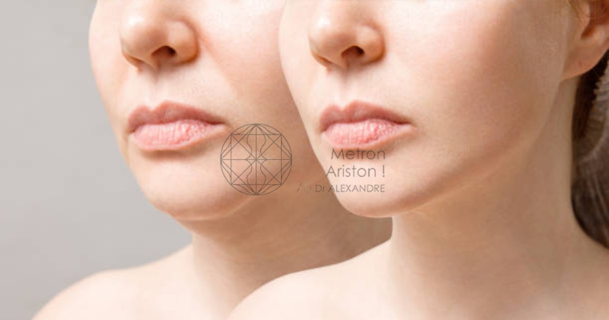 Liposuction Chin Before And After