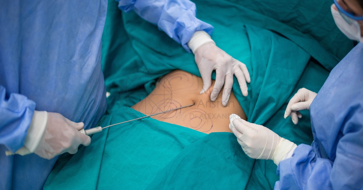 What Is The Price Of Stomach Liposuction