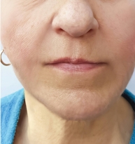 Minimal Access Liposculpture Facelift (MALF)