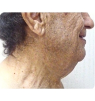 Minimal Access Liposculpture Facelift (MALF)