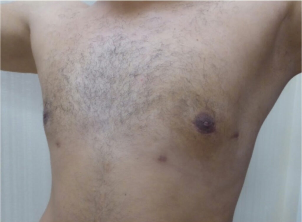 MIGS (Minimally Invasive Gynecomastia Surgery)