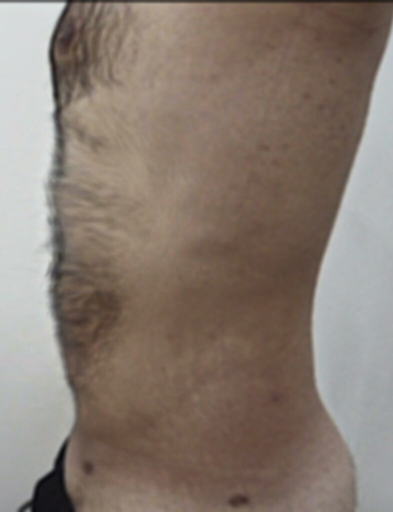 SLIT (Superior Liposculpture & Intensive Tightening)