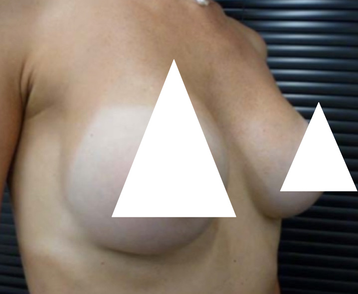 FABS (Functional Aesthetically balanced Breast Surgery)