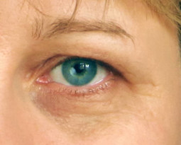 Blepharoplasty