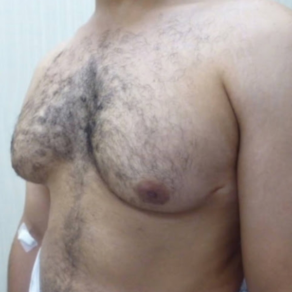 Gynecomastia