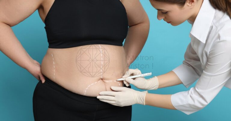 Does Liposuction Work For Belly Fat