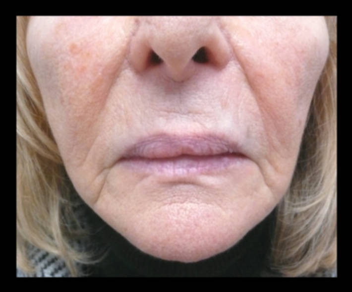 Dermal Fillers