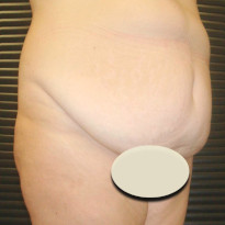 Abdominoplasty