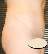 Abdominoplasty