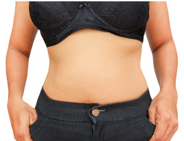 Abdominoplasty