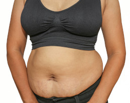 Abdominoplasty