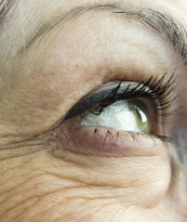 Blepharoplasty