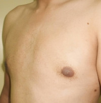 Gynecomastia