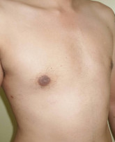 Gynecomastia