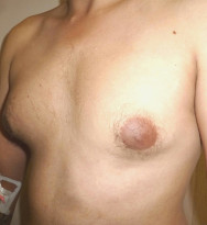 Gynecomastia